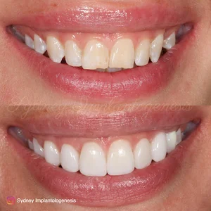 Lumiere Dental Implants and Wisdom Tooth extraction Centre