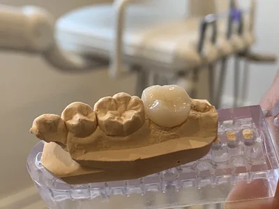 Laser Root Canal Sydney